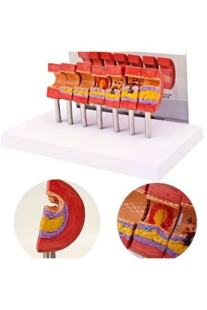 نموذج تعليمي لتصلب الشرايين