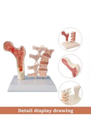 نموذج هشاشة العظام