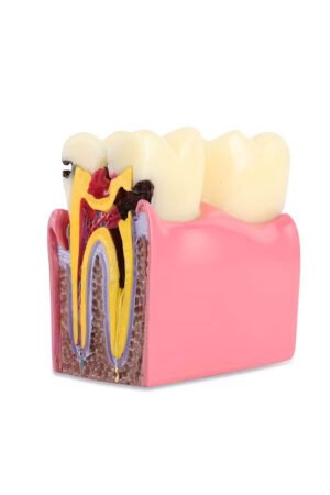 نموذج تسوس الأسنان